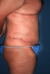 Abdominoplasty 10 postop lateteral