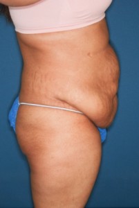 Abdominoplasty 10 preop lateral
