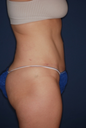 Abdominoplasty 2 postop lateral