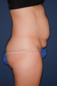 Abdominoplasty 2 preop lateral