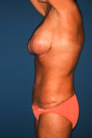 Abdominoplasty 3 preop lateral, combined procedure one preop