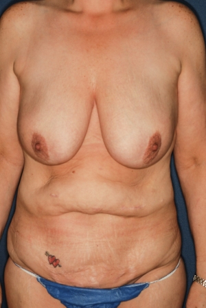 Abdominoplasty 3 preop, combined procedure 1 preop