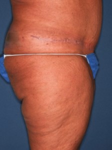 Abdominoplasty 4 postop lateral