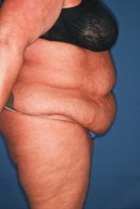 Abdominoplasty 4 preop lateral