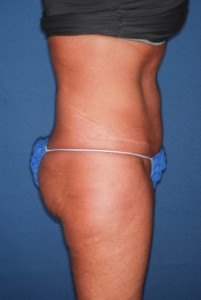 Abdominoplasty 5 postop lateral