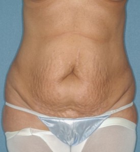 Abdominoplasty 5 preop