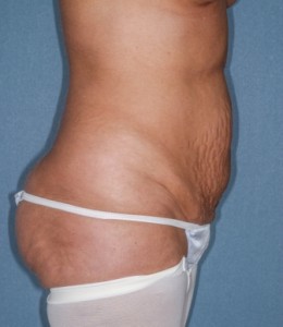 Abdominoplasty 5 preop lateral