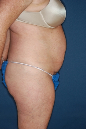 Abdominoplasty 6 preop lateral