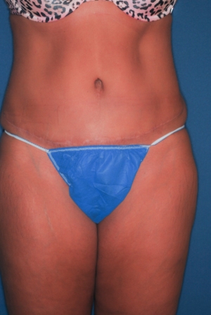 Abdominoplasty 7 postop