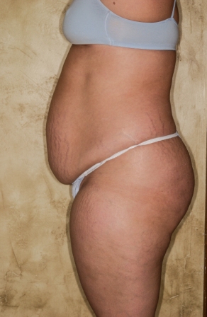 Abdominoplasty 8 preop lateral