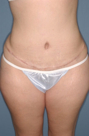 Abdominoplasty 9 postop