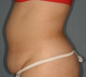 Abdominoplasty 9 preop lateral