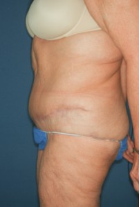 Abdominoplasty Massive weight loss 1 postop lateral