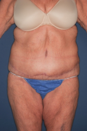 Abdominoplasty Massive weight loss 1 postop