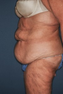 Abdominoplasty Massive weight loss 1 preop lateral