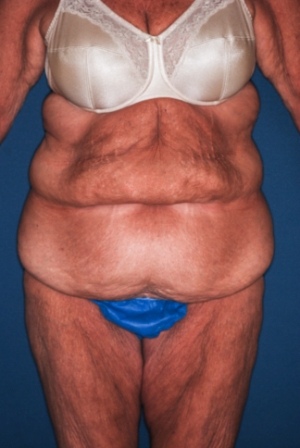 Abdominoplasty Massive weight loss 1 preop