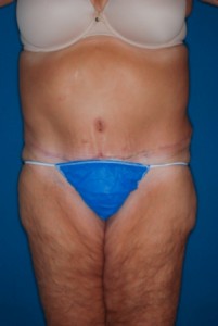Abdominoplasty Massive weight loss 2 postop