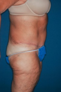 Abdominoplasty Massive weight loss 2, postop lateral