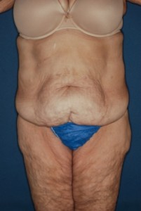 Abdominoplasty Massive weight loss 2 preop