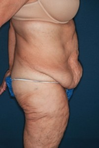 Abdominoplasty Massive weight loss 2 prop lateral