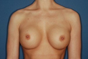 Breast Augmentation 4 Postop