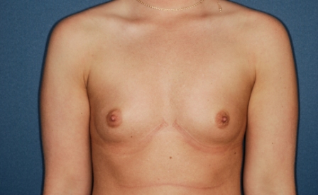 Breast Augmentation 5 Preop