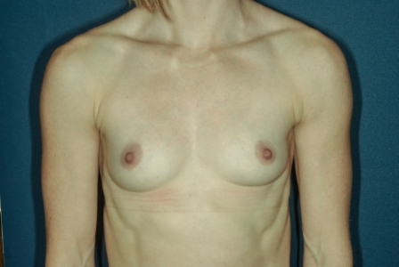 Breast Augmentation 6 Preop