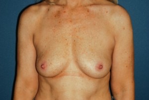 Breast Augmentation 7 Preop
