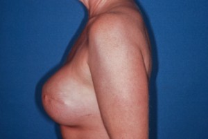Breast Reconstruction 2 postop lateral