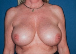 Breast Reduction 1 preop - Lubbock Plastic Surgery