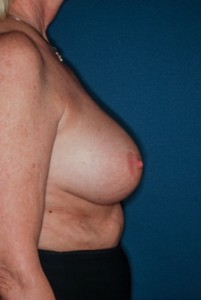 Breast Reduction 1 preop lateral - Lubbock Plastic Surgery
