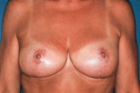 Breast Reduction 2 postop - Lubbock Plastic Surgery