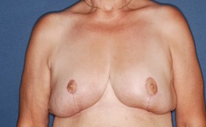 Breast Reduction 3 post lateral - Lubbock Plastic Surgery