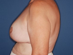 Breast Reduction 3 postop lateral - Lubbock Plastic Surgery