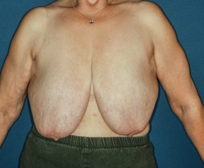 Breast Reduction 3 preop lateral - Lubbock Plastic Surgery