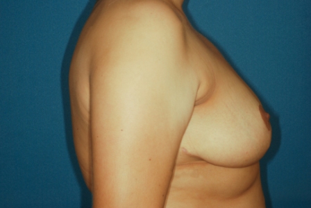 Breast Reduction 4 postop lateral - Lubbock Plastic Surgery