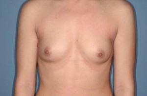 Breast Augmentation 12 Preop