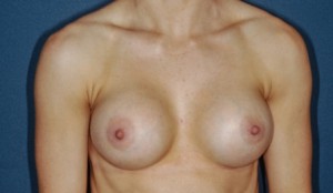 Breast Augmentation 6 Postop