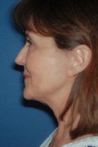 Facelift 1 postop lateral - Lubbock Plastic Surgery