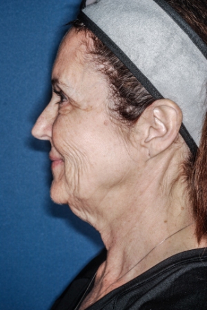 Facelift 1 preop lateral - Lubbock Plastic Surgery