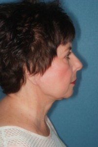 Facelift 2 postop lateral -Lubbock Plastic Surgery