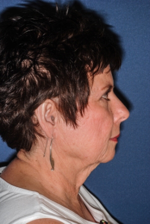 Facelift 2 preop lateral -Lubbock Plastic Surgery