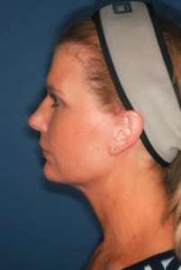 Facelift 3 postop lateral -Lubbock Plastic Surgery