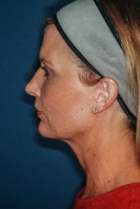 Facelift 3 preop lateral -Lubbock Plastic Surgery