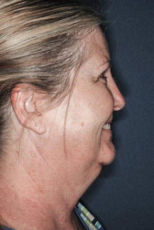 Submental liposuction 1 preop lateral