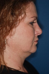 Submental liposuction 2 preop lateral