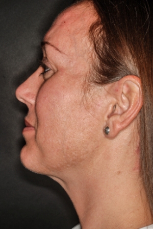 Submental liposuction 3 postop lateral